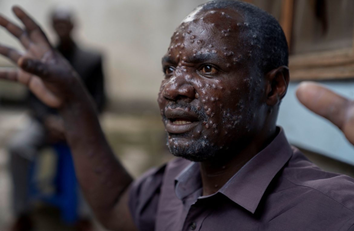 L Afrique CDC déclare l mpox urgence en santé publique